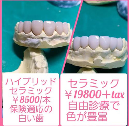 気になるその銀歯 保険治療で白くできます ハイブリッドセラミック 8 500 3割負担時 あい歯科 長堀橋院 土日祝日も夜10時まで 急患いつでも対応 ネット予約受付24h